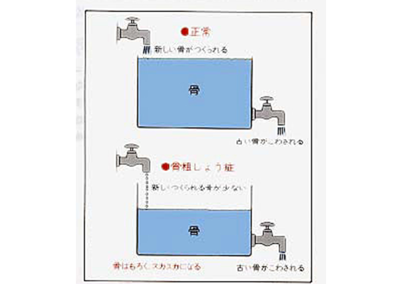 骨粗しょう症